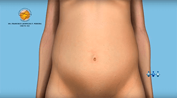 Procedimento cirgurgico